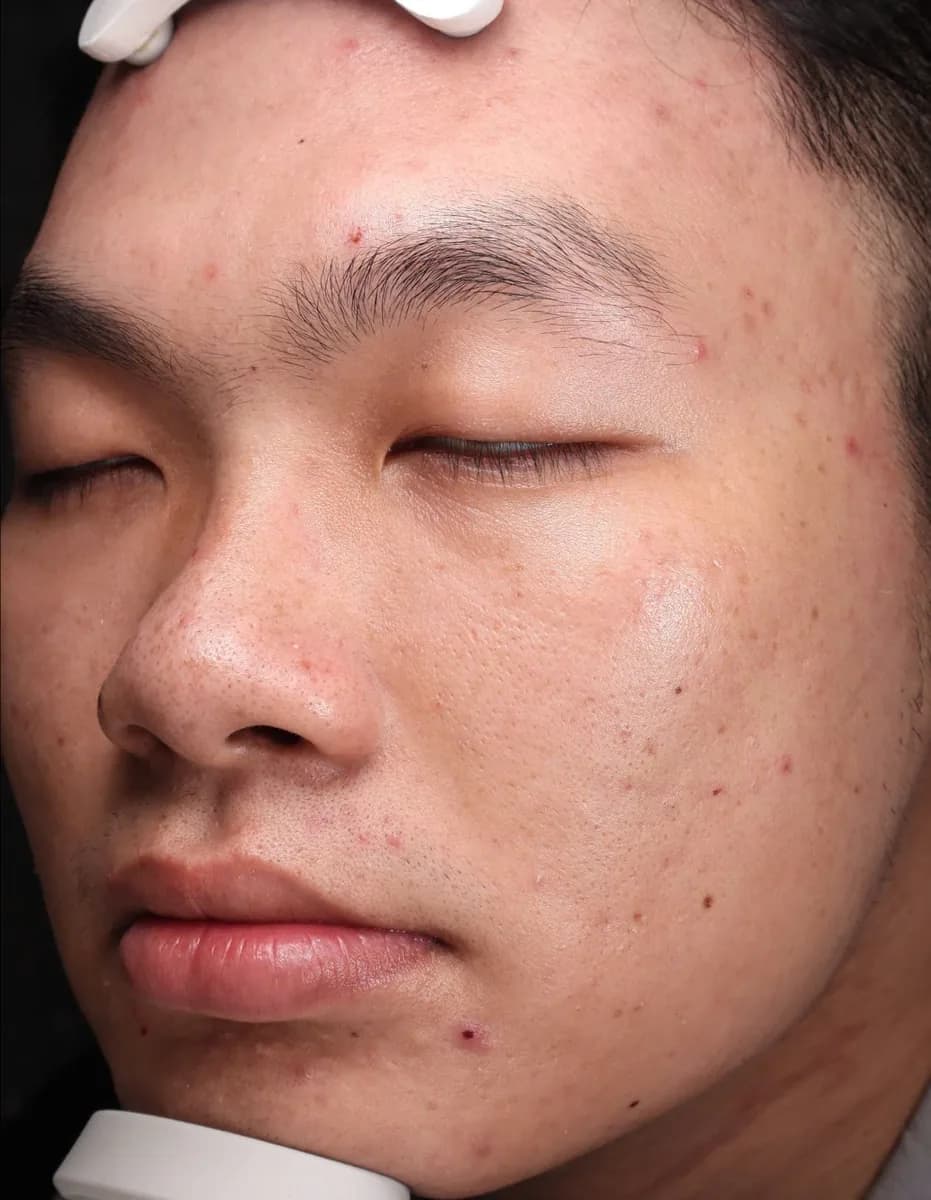 UltraClear laser before photo — pigmentation & melasma at Weston Center for Plastic Surgery