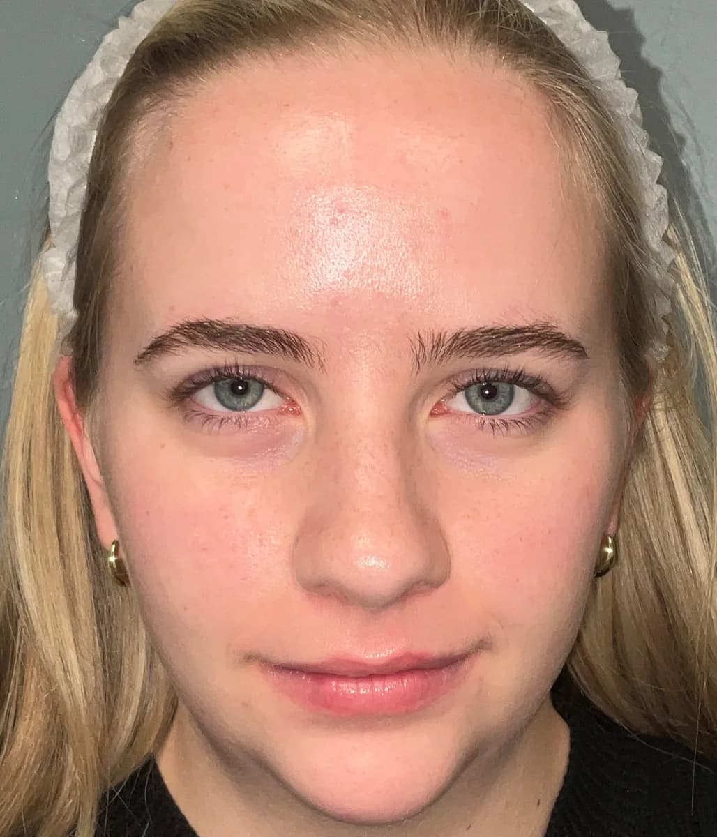 UltraClear laser after photo — uneven tone & breakouts at Weston Center for Plastic Surgery