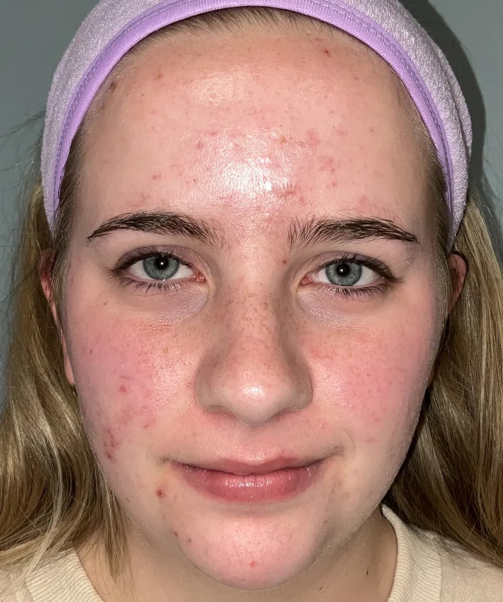 UltraClear laser before photo — uneven tone & breakouts at Weston Center for Plastic Surgery