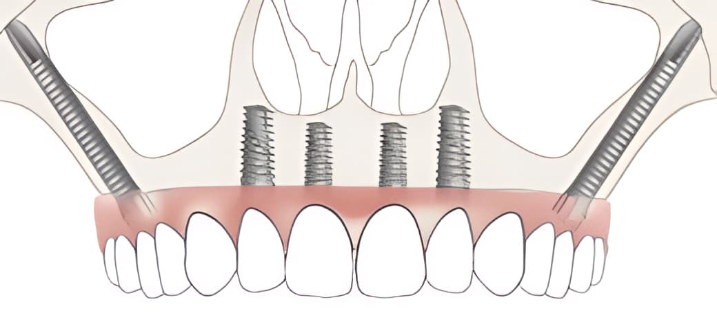 Zygomatic implants combined with conventional anterior implants