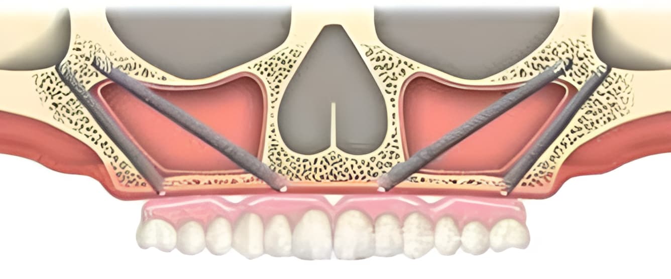 Quad zygomatic implant placement for the totally resorbed maxilla